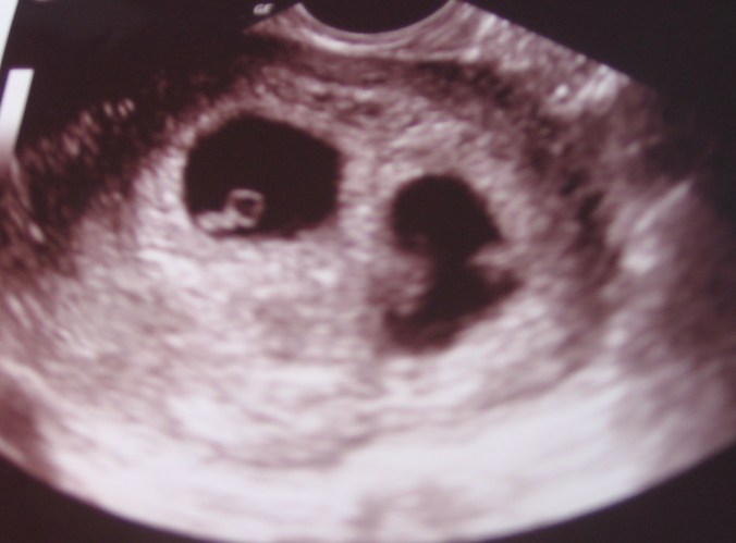 my first glimpse of twins during my first ultrasound at 6 weeks